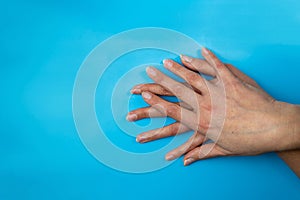 Female hands with nails affected by fungus on a blue background. Hand health and hygiene photo