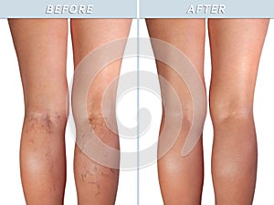 Female healthy leg and the affected varicose veins