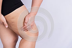 Female holding and pushing the skin of the legs cellulite or orange peel. Treatment and disposal of excess weight, the deposition