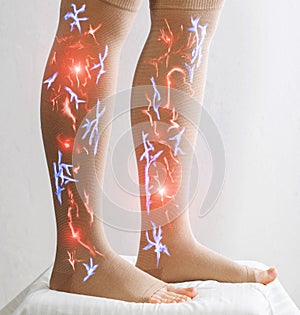 Female legs in compression stockings for varicose veins on the legs. White background. Circulation in the legs