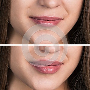 Female lips before and after augmentation