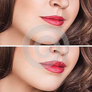 Female lips before and after augmentation