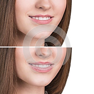 Female lips before and after augmentation