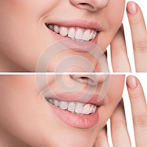 Female lips before and after augmentation photo