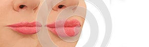 female lips before and after augmentation beauty