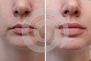 Female lips before and after augmentation, the result of using hyaluronic filler