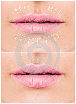 Female lips. Woman lips before and after lip filler injections