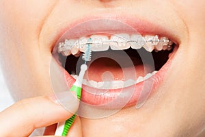 Female mouth with braces and interdental brush