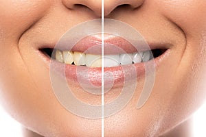 Female mouth. Comparison before and after teeth whitening
