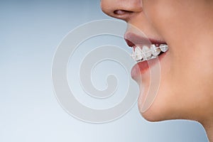 Female Mouth With Metal White Dental Braces