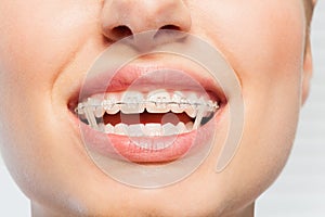 Female mouth with orthodontic elastics on braces photo