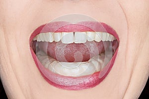 Female mouth teeth grind guard photo