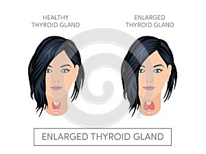 Female with normal and enlarged thyroid gland