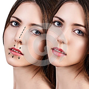 Female nose before and after cosmetic surgery