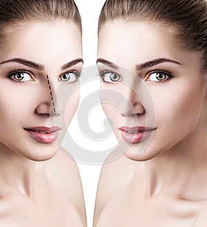 Female nose before and after cosmetic surgery