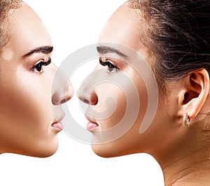 Female nose before and after cosmetic surgery.