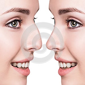 Female nose before and after cosmetic surgery