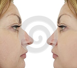 Female nose hump correction before after procedures