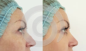 Female nose hump correctionblem, before and after before after procedures