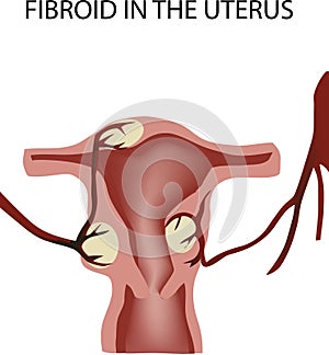 Female organ tumor disease fibroid- photo