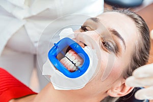 Female patient undergoing teeth whitening procedure