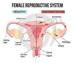 Female reproductive system, endometriosis.Scheme of gynecological diseases of the uterus.The state of growth of external tissues w