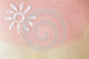 Female skin with red burn after sunburn on the beach