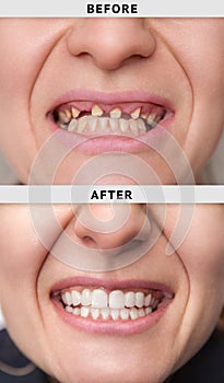 female smile after and before dental