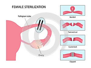 Female sterilization, Tubal ligation