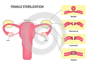 Female sterilization, Tubal ligation