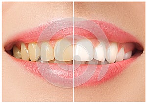 The female teeth before and after whitening.