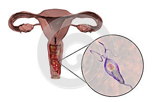 Female trichomoniasis, illustration showing vaginitis and close-up view of Trichomonas vaginalis parasite photo