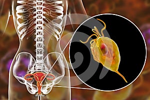 Female trichomoniasis, illustration showing Trichomonas vaginalis parasite