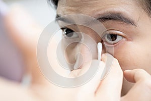 Female using a cotton bud swab to wipe clean the swollen,itchy area,problems of eyelid is rolled inward against the eyeball,