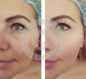 female wrinkles mature before and after correction regeneration therapy treatments