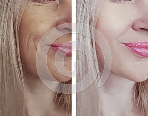 Female wrinkles results before and after treatments