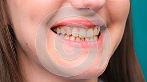 Female Yellow teeth, fluorosis. Smokers problem teeth caused by fluoride, smoking, or coffee. Brown tooth enamel due to