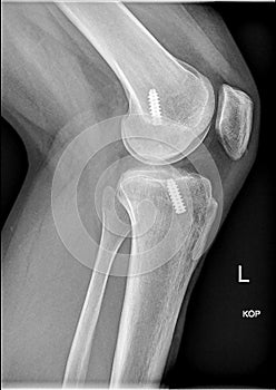 Femoral interference screw, Anatomical reconstruction of anterior cruciate ligament of the knee