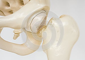 Femoral neck fracture - 3D Rendering