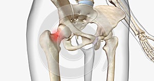 A femoral neck fracture is a type of hip fracture that occurs in the section of the femur closest to the pelvis