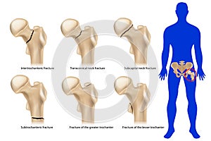 Femoral neck fracture. Types of hip fractures. Subtrochanteric, Intertrochanteric, Transcervical and Subcapital neck photo