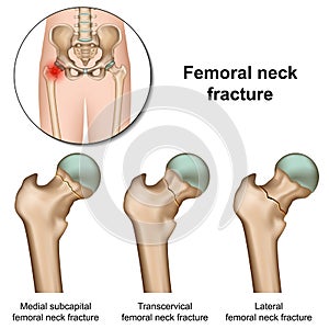 Femoral neck fractures medical  illustration on white background