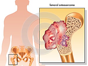 Femoral osteosarcoma