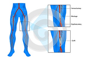 Femoral popliteal also called femoropopliteal or Fem-Pop bypass surgery.