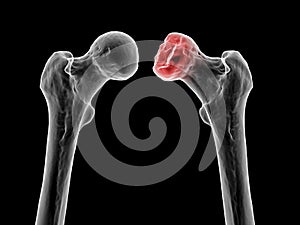 Femur bone affected by Legg-Calve-Perthes Disease, a childhood hip disorder, 3D illustration