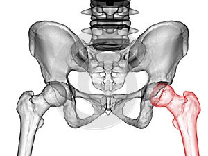 Femur bone affected by Legg-Calve-Perthes Disease, a childhood hip disorder, 3D illustration
