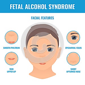 Fetal alcohol syndrome facial features in a child