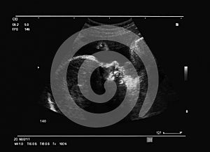 Fetus ultrasound