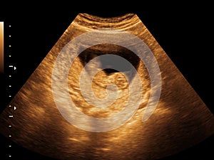 Fetus Ultrasound photo