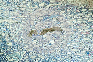 Fibrin deposits in the kidney, microscopy